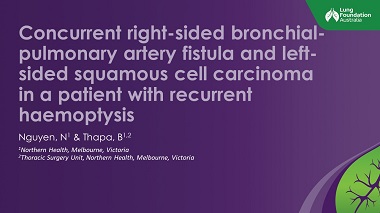 Concurrent right-sided bronchial-pulmonary artery fistula and left-sided basaloid squamous cell carcinoma in a patient with recurrent haemoptysis
